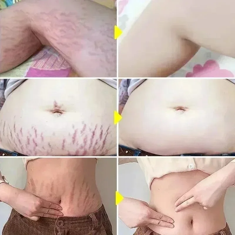 Stretch Marks Permanent Remova - đánh giá và giá Skincare Oat